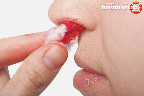Как помочь остановить кровотечение из носа