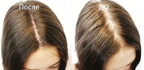 Лечение выпадения волос